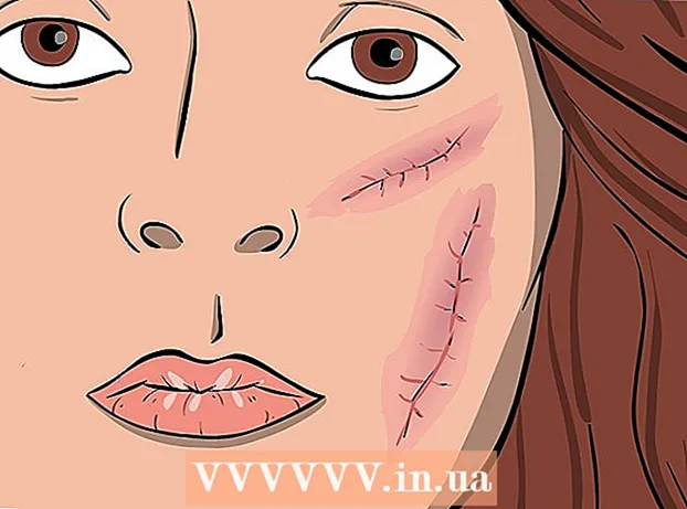 Remediar el acné con formación de quistes.
