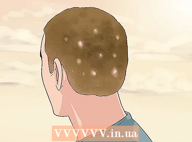 Kopfhaut Psoriasis erkennen