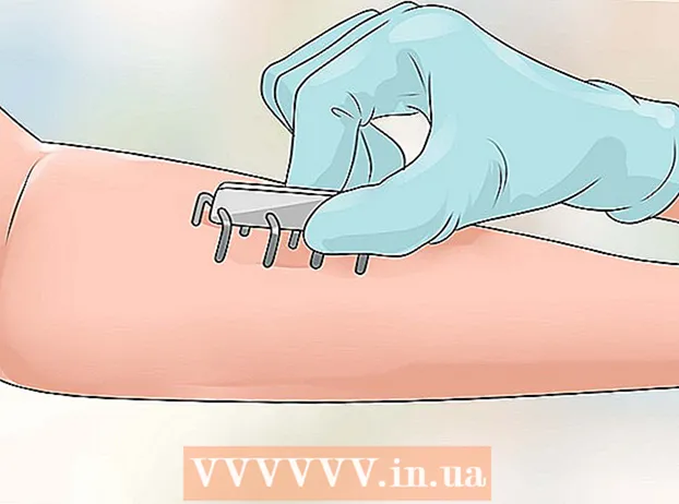 Kako se riješiti akni na stražnjici