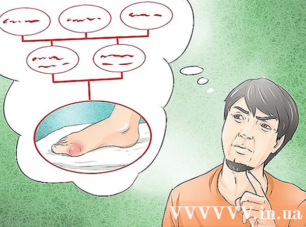 Jak złagodzić ból spowodowany dną moczanową w domu