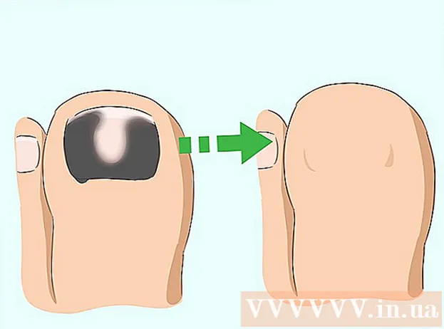 Hur man behandlar svarta naglar