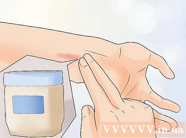Как да лекуваме леки изгаряния