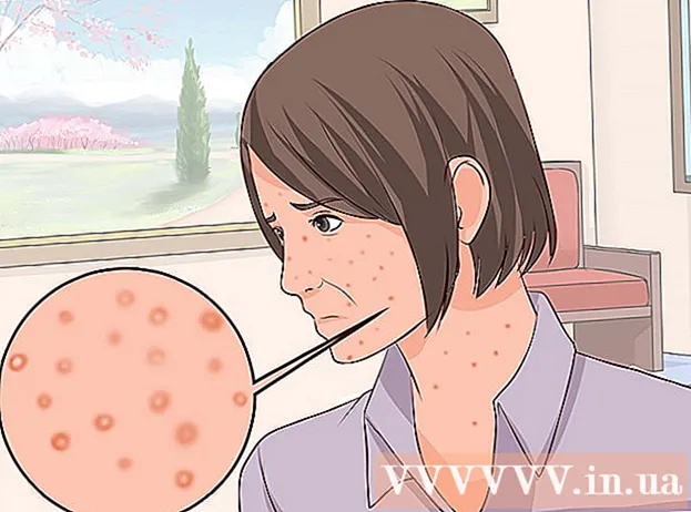Cómo identificar la varicela