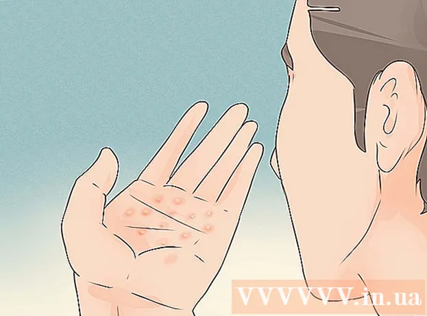 How to Treat Eczema