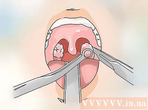 Hvernig á að meðhöndla tonsillitis