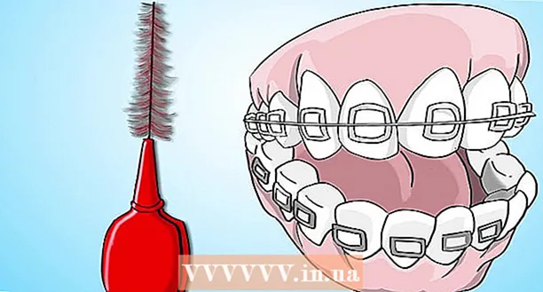 How to brush your teeth with braces