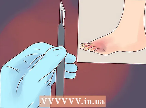 Як лікувати стафілококову інфекцію