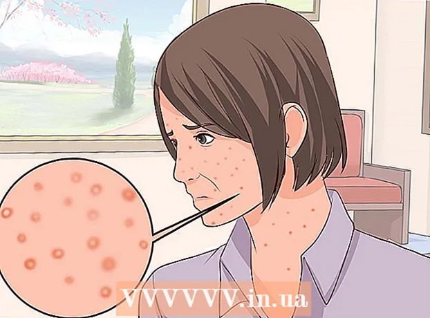 Cómo reconocer la varicela