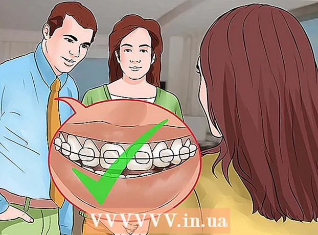 Comment rendre les appareils dentaires moins visibles